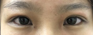 S__114573320切開下垂術後