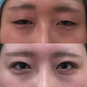 S__114548742下垂埋没