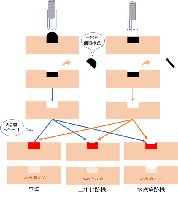 蒸散・炭酸ガスレーザー治療