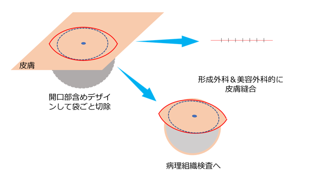 粉瘤の手術