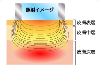 フォトR Fフェイシャル　e Light 3倍照射