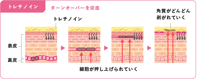 トレチノインとハイドロキノンとは？