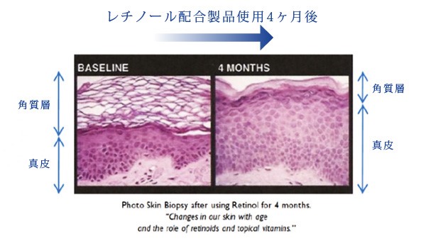 トレチノインとレチノール