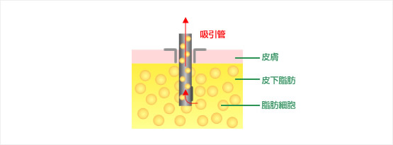 脂肪吸引施術